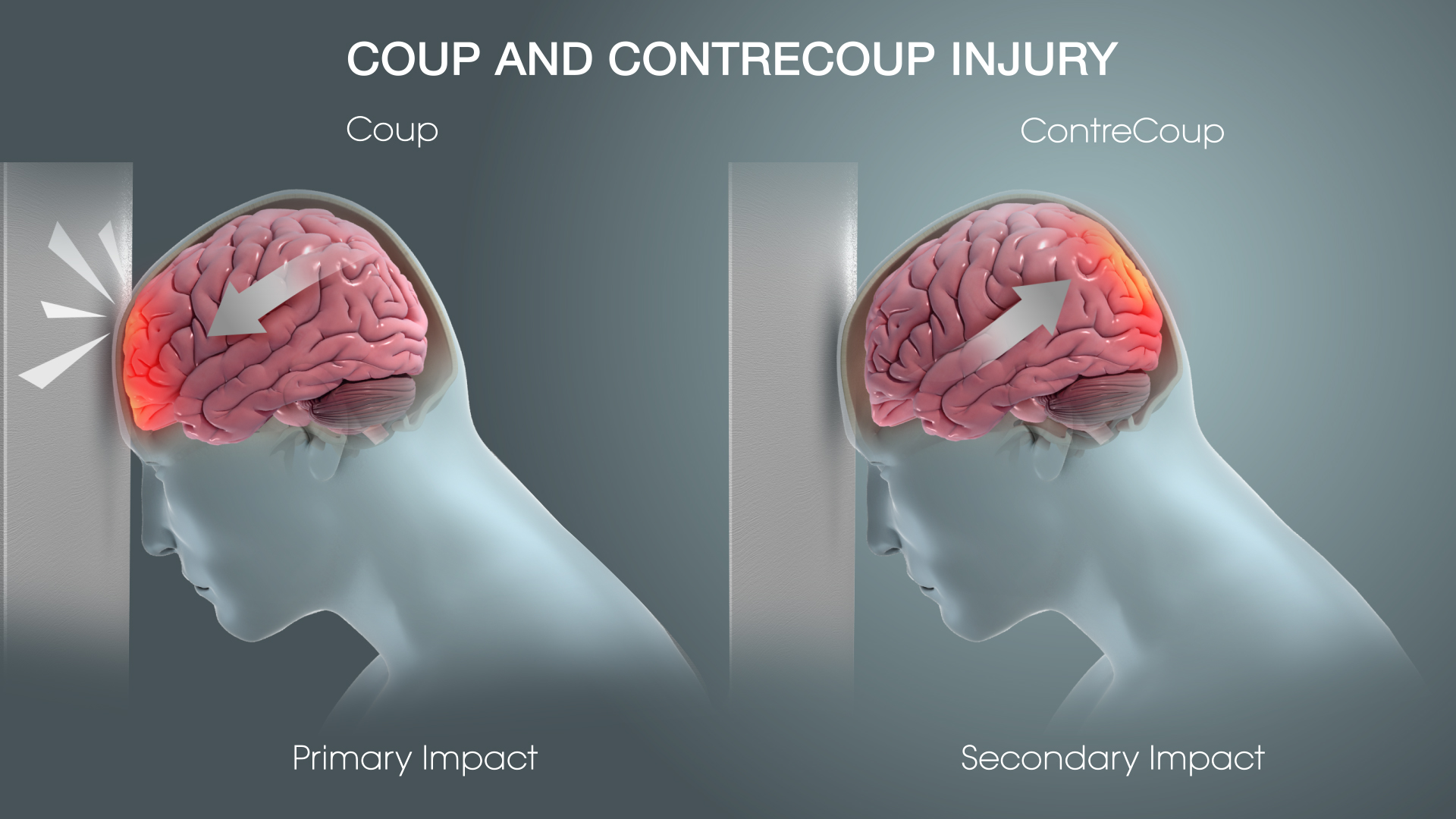 Understanding Hematomas And Traumatic Brain Injury Scientific Animations