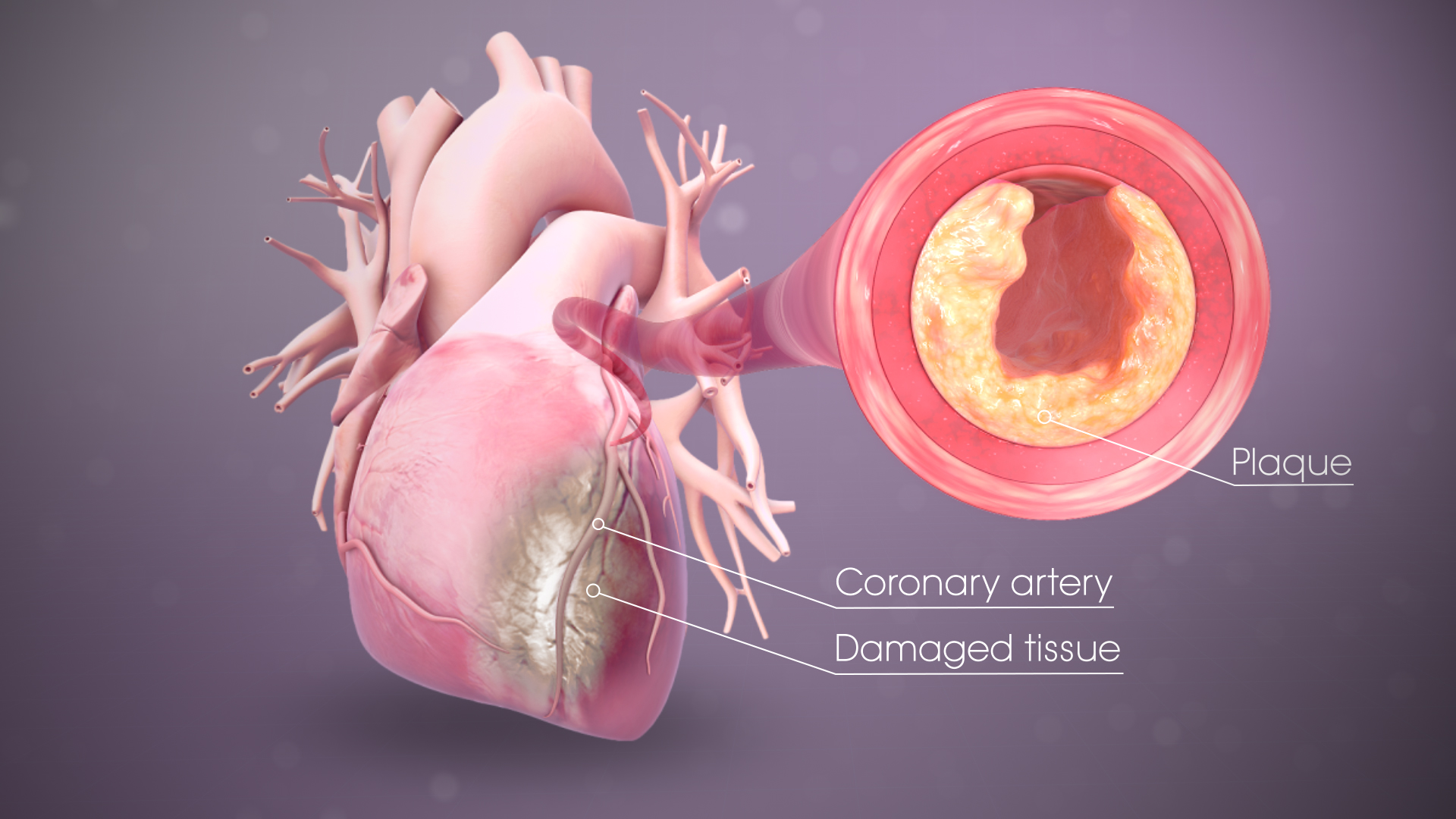 Myocardial Infarction Heart Attack Symptoms Causes And Treatment