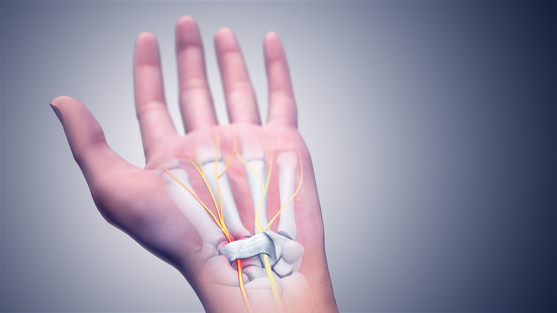 Carpal Tunnel Syndrome CTS Cause Pathophysiology And Treatments