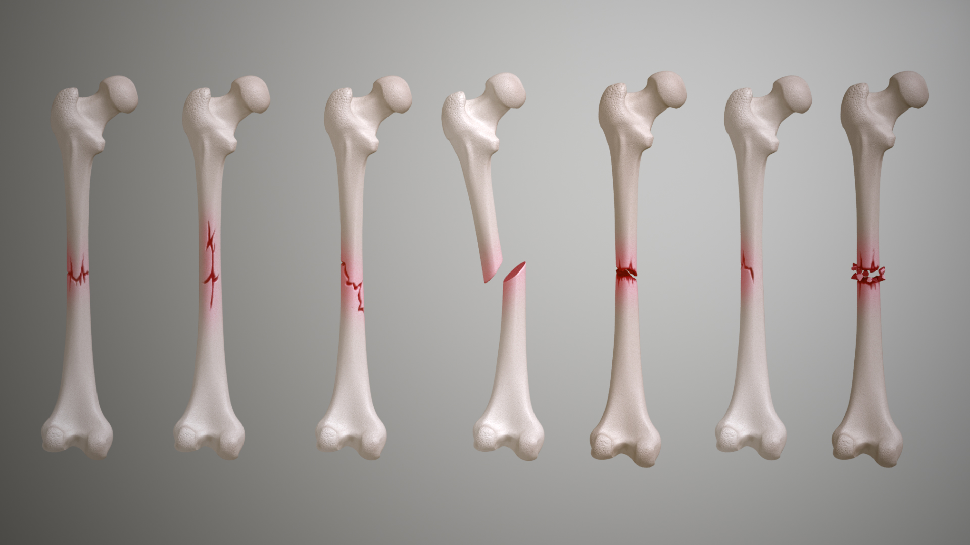 Fractures Types Symptoms Causes And Treatment Scientific Animations