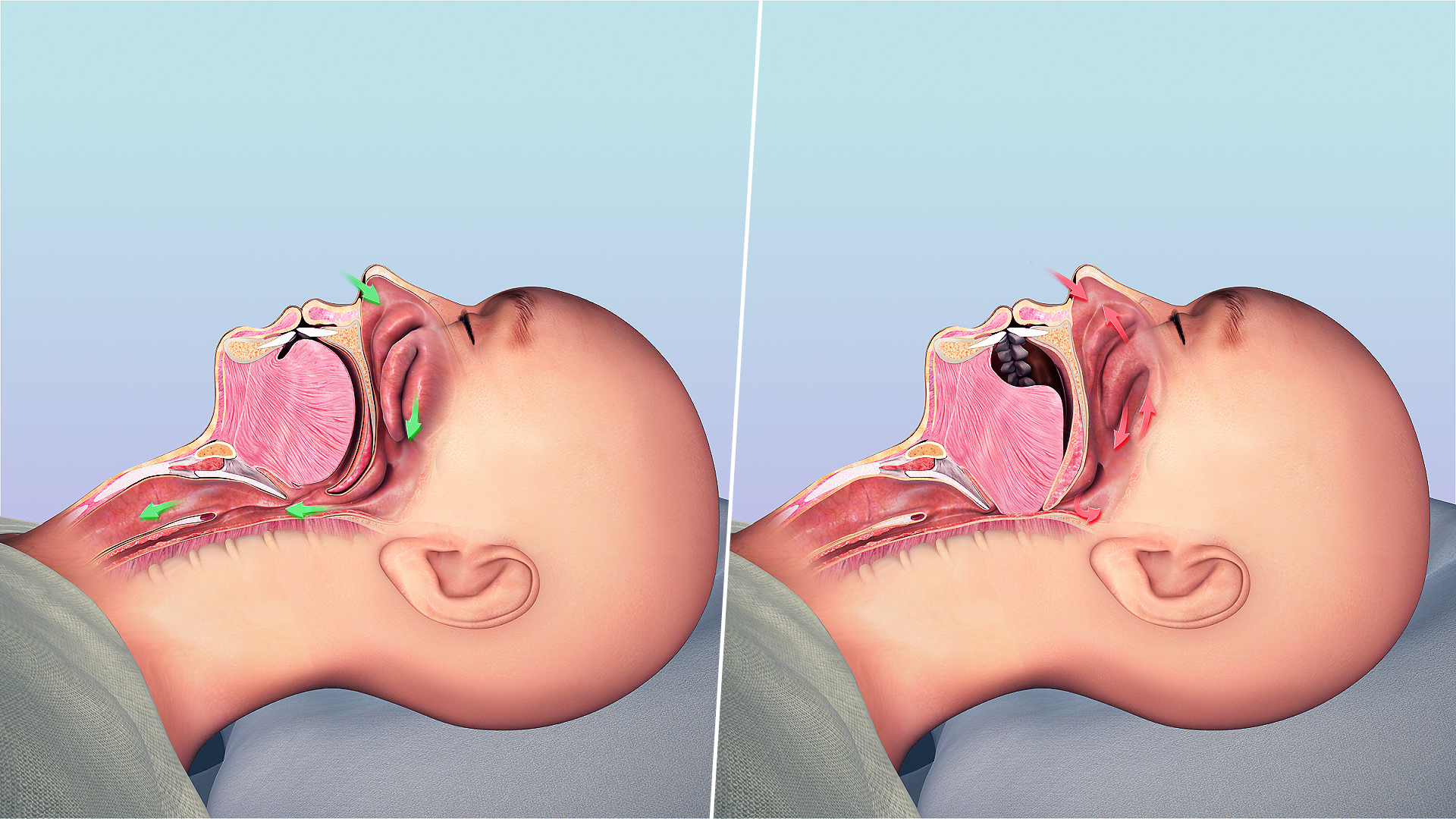 Sleep Apnea Causes Symptoms And Treatment Scientific Animations