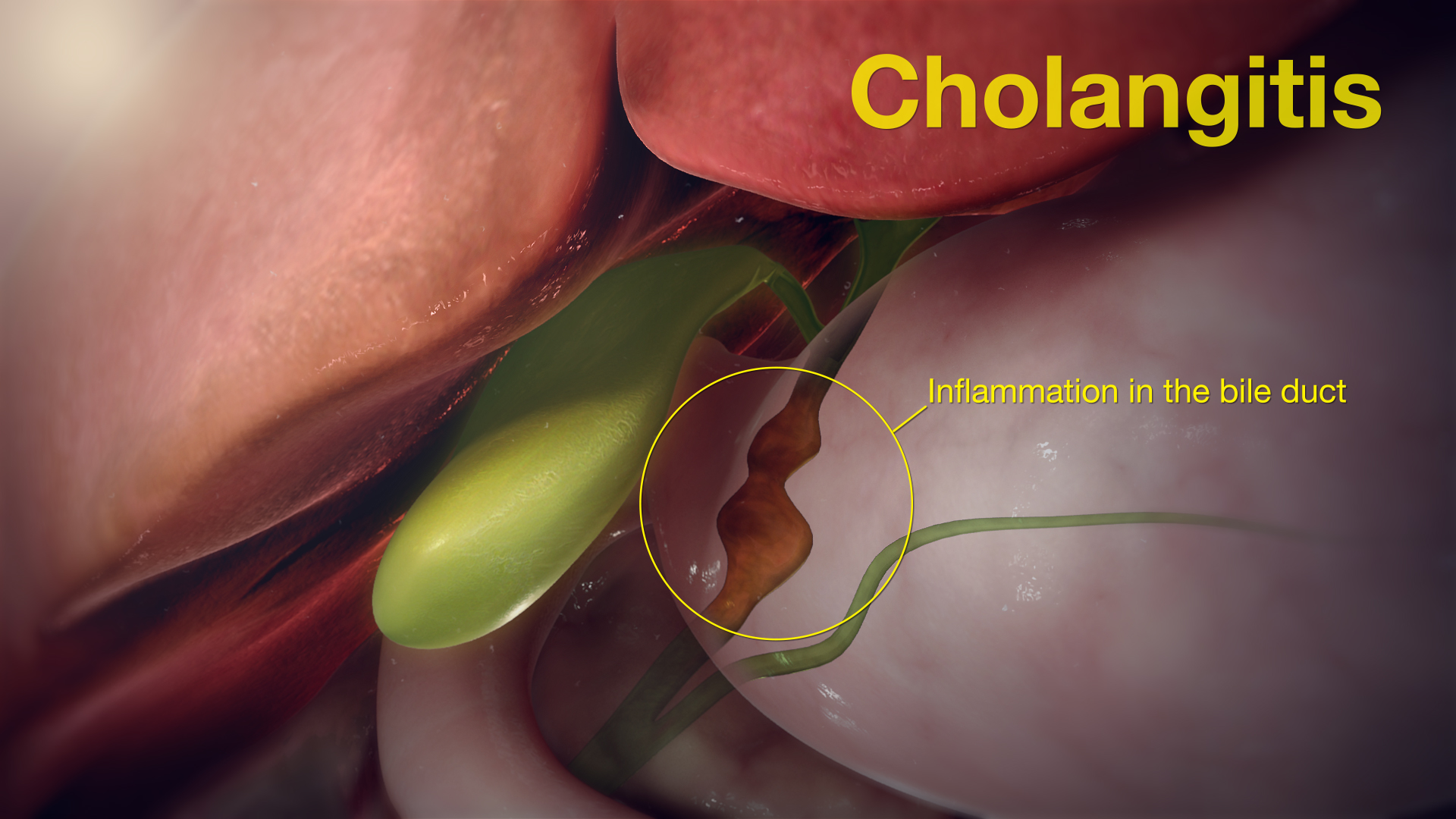 Cholangitis Symptoms Causes And Treatment Scientific Animations