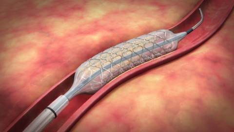 Cardiac Stent deployed via Balloon Catheter - Scientific Animations