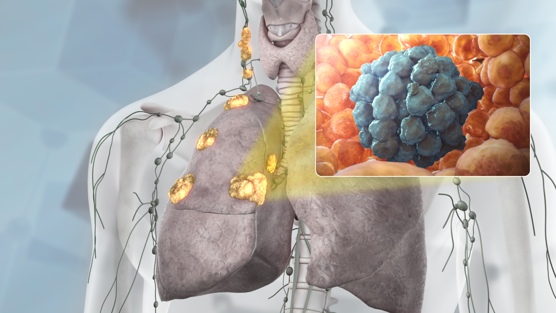 Radiation Therapy For Lung Cancer Stage 3 All About Radiation