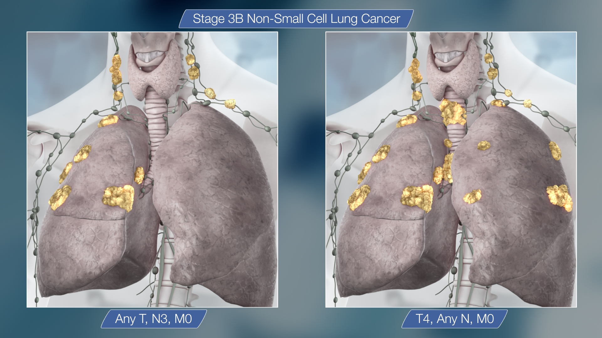 Stage 3 Lung Cancer All That You Need To Know Scientific Animations