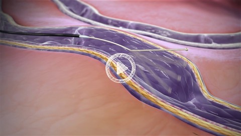 Sclerotherapy Procedure- 3D Medical Animation - Scientific Animations