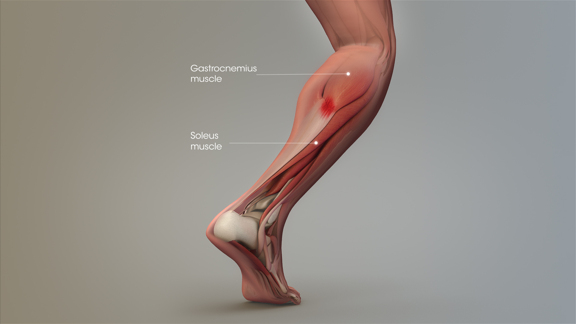 Tennis Leg and Achilles Tendonitis: Confusing The Two Can ...