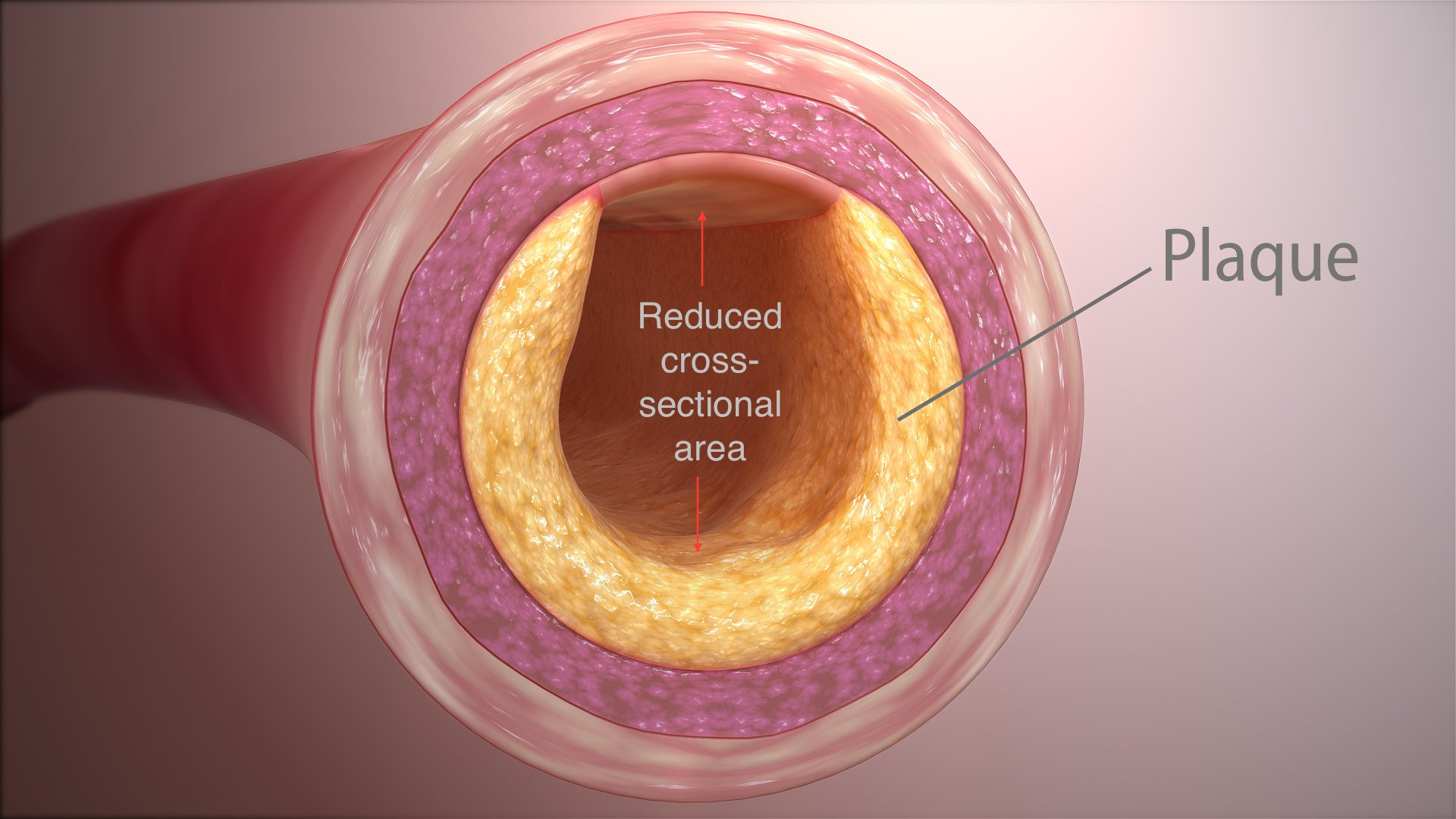 How Clearing Heart s Clogged Arteries Similar To Restoring A Monument