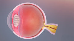 A medical animation still showing Ophthalmology Optical Nerve