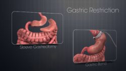 Squeezing Stomachs To Get Rid Of Obesity: An Account On Gastric Restriction