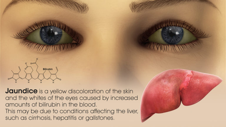 hypothesis on jaundice