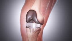 Knee Replacement Surgery: The most popular orthopedic procedure