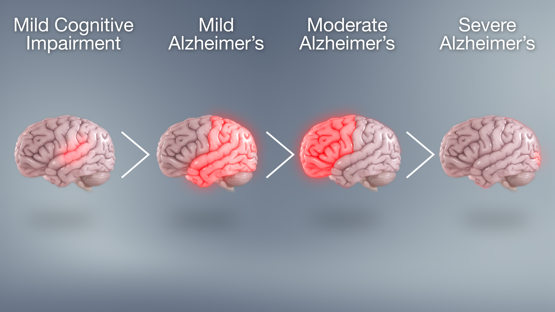 new research on alzheimer's