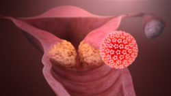 Cervical cancer caused by HPV