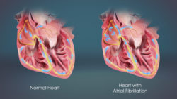 Atrial Fibrillation & Related Cardiac Risks