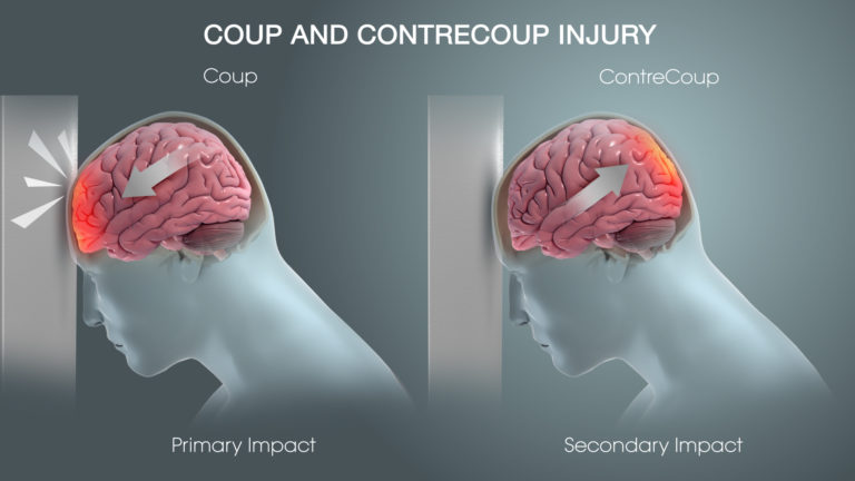 coup-contrecoup-injury-scientific-animations