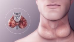 3D medical animation still showing Liver Cancer