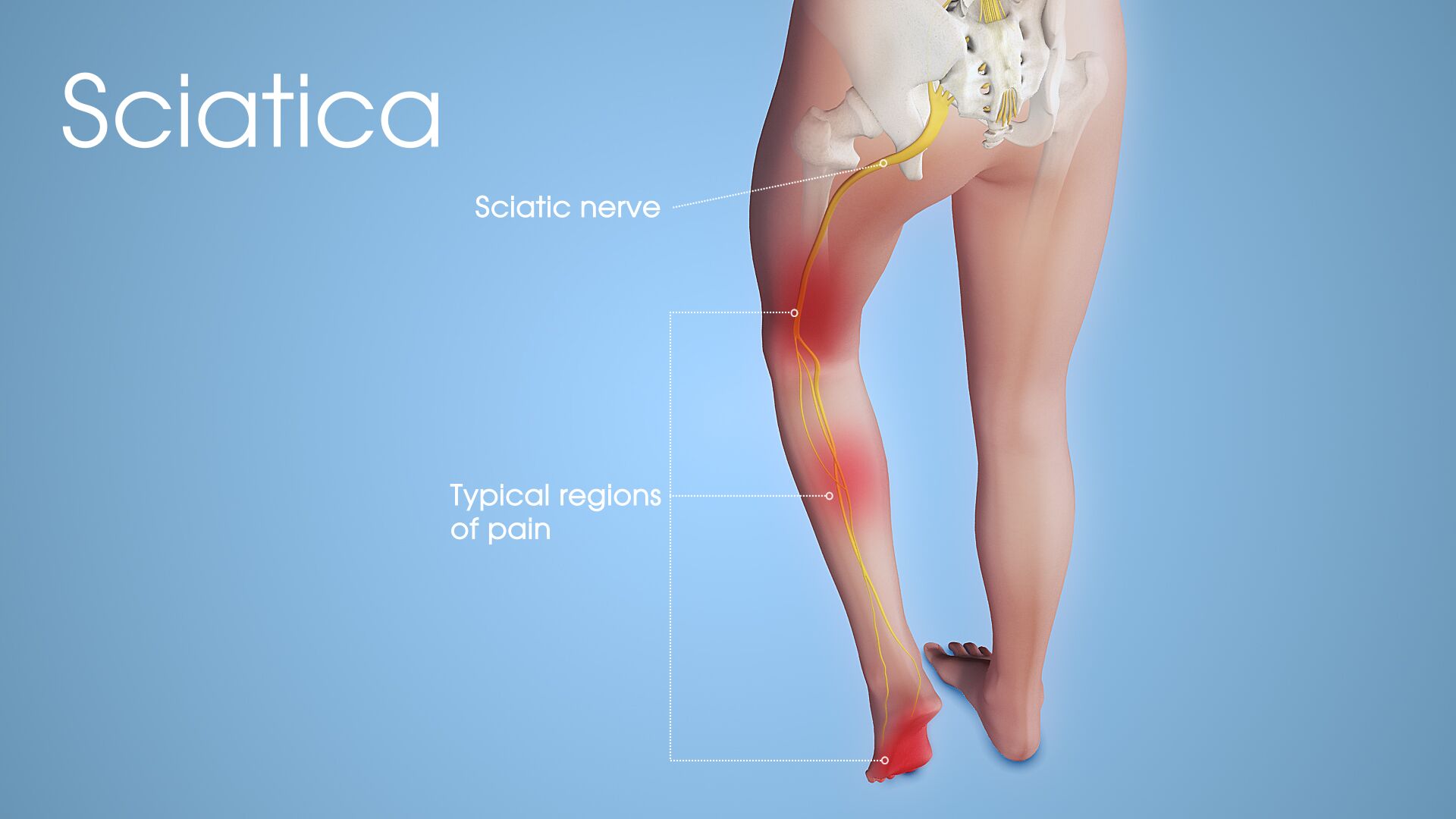 Sciatica Causes Pathophysiology Management And Treatment