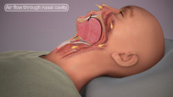 A medical animation still showing normal air movement and airway structure. An obstruction in the normal air movement may cause snoring.