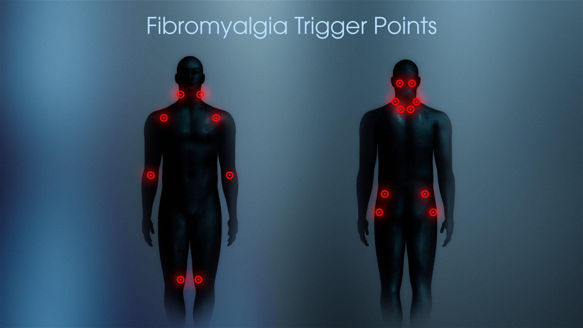 3D Medical Animation showing Fibromyalgia Trigger points