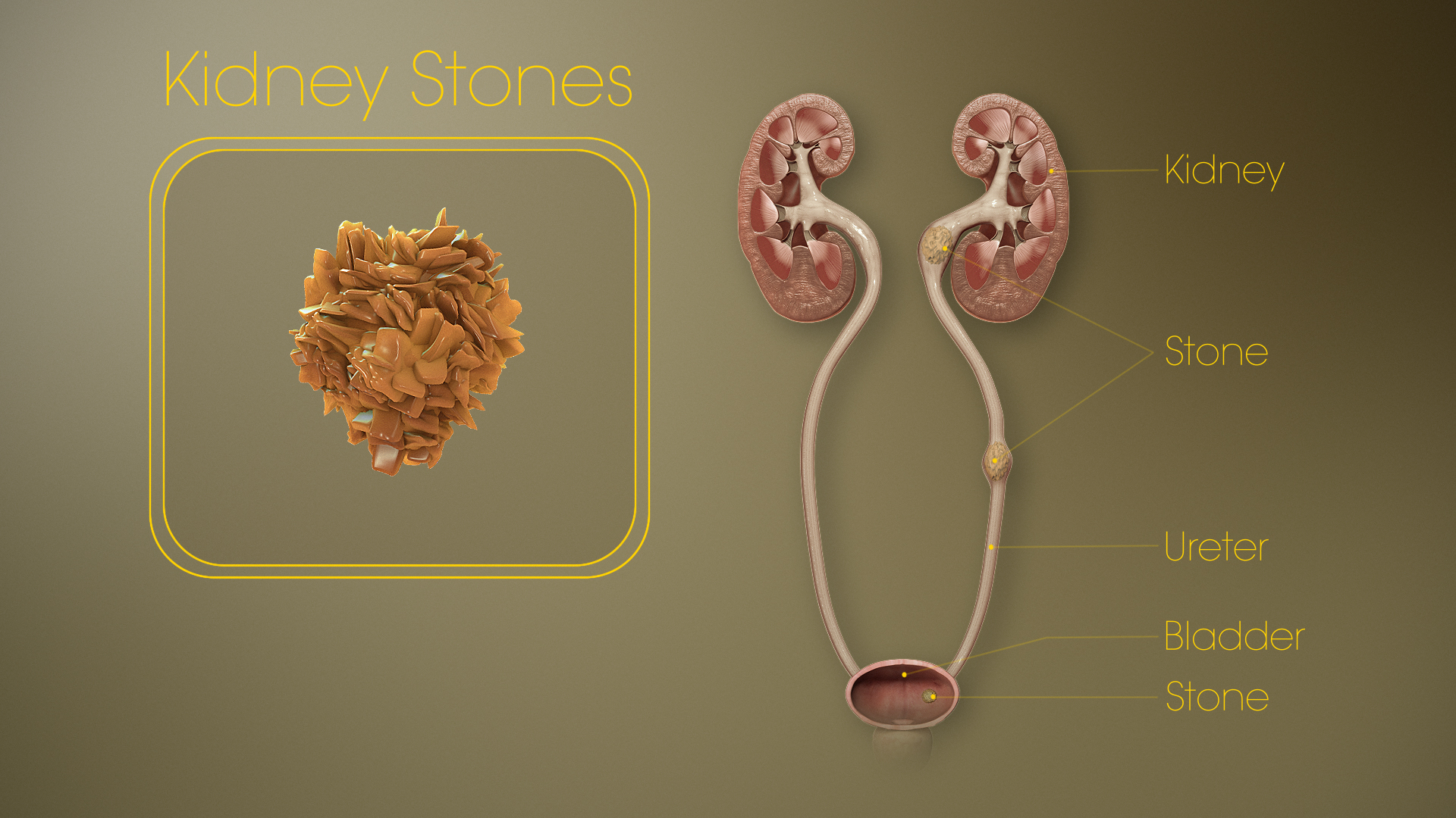 Why People Get Kidney Stones