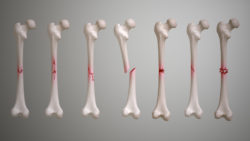 3D medical animation still showing types of Bone Fractures