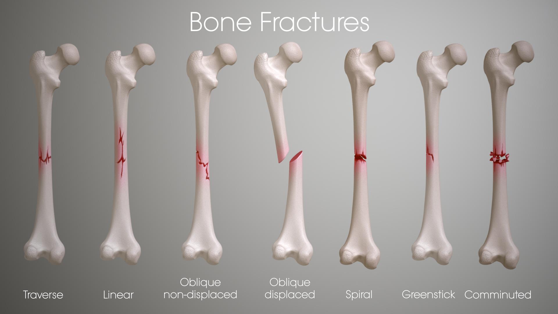 bone fracture vs break