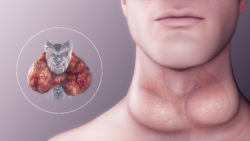 3D medical animation still showing hypothyroidism