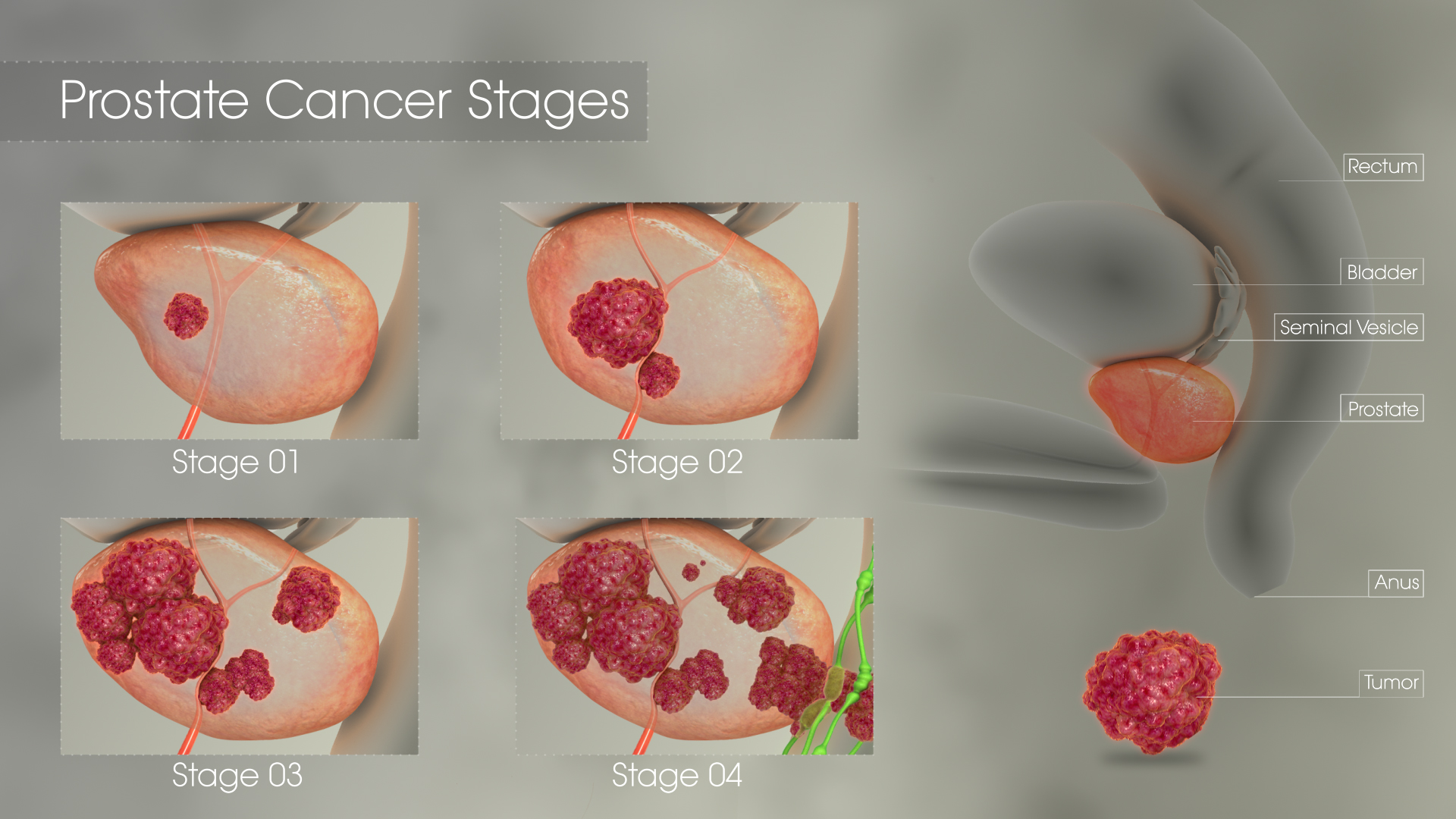 Prostate Cancer Stages Scientific Animations