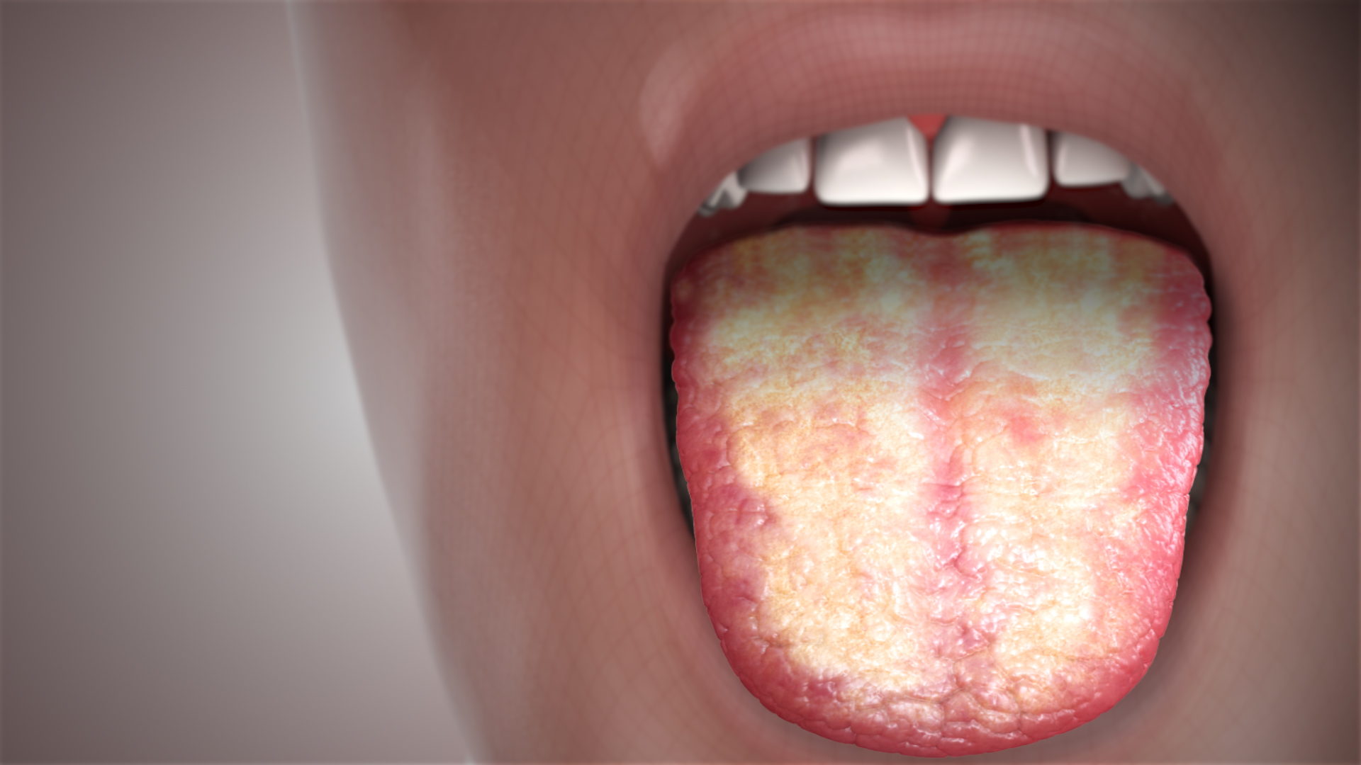 candidiasis-fi-scientific-animations