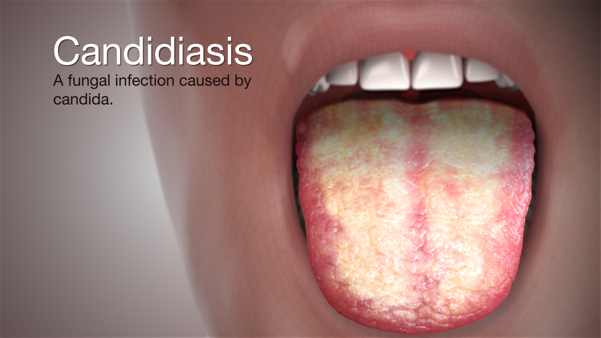 candidiasis tongue treatment