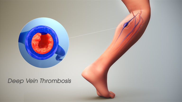 Deep Vein Thrombosis - Scientific Animations