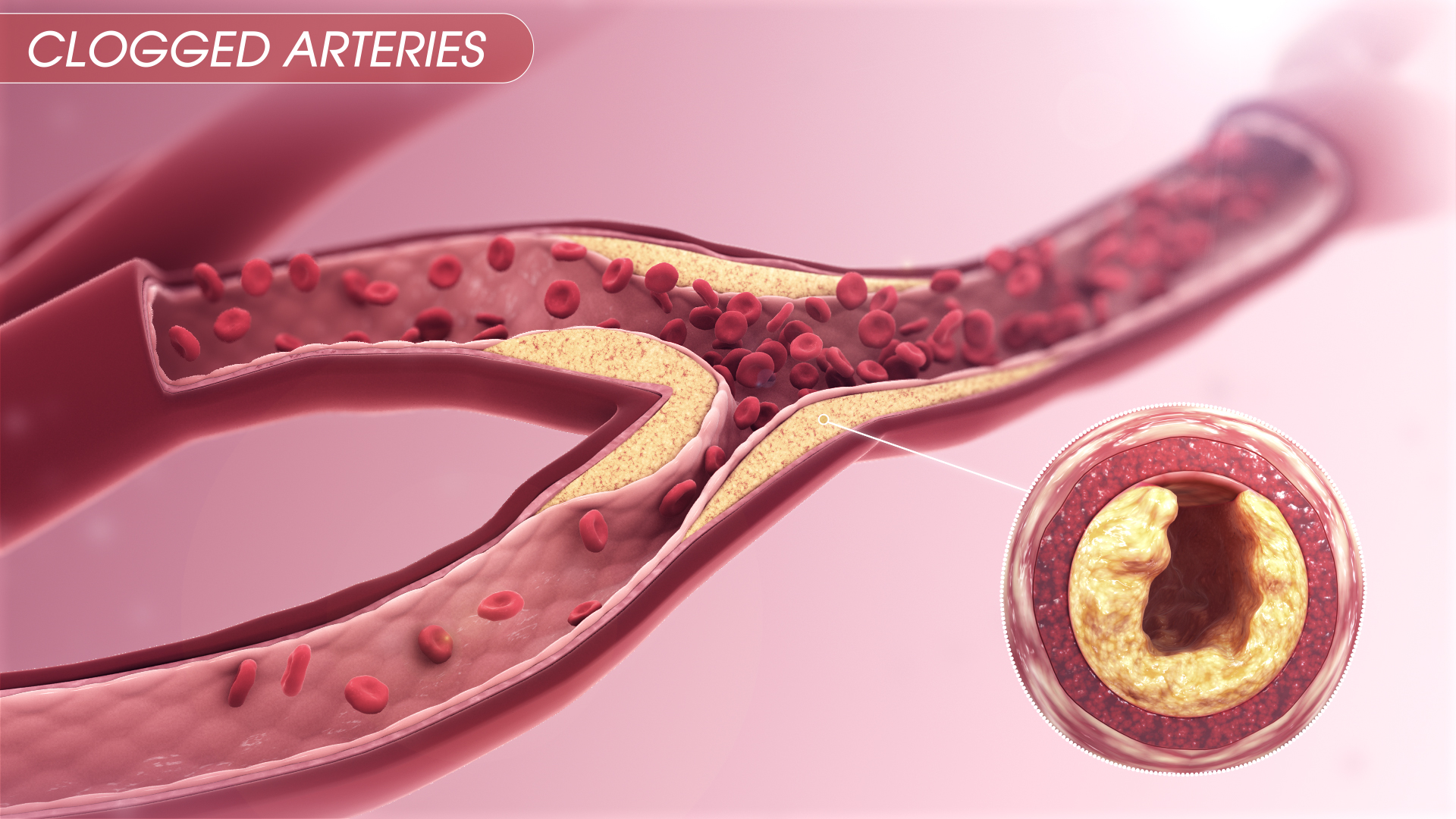 Clogged Arteries Scientific Animations   Clogged Arteries 