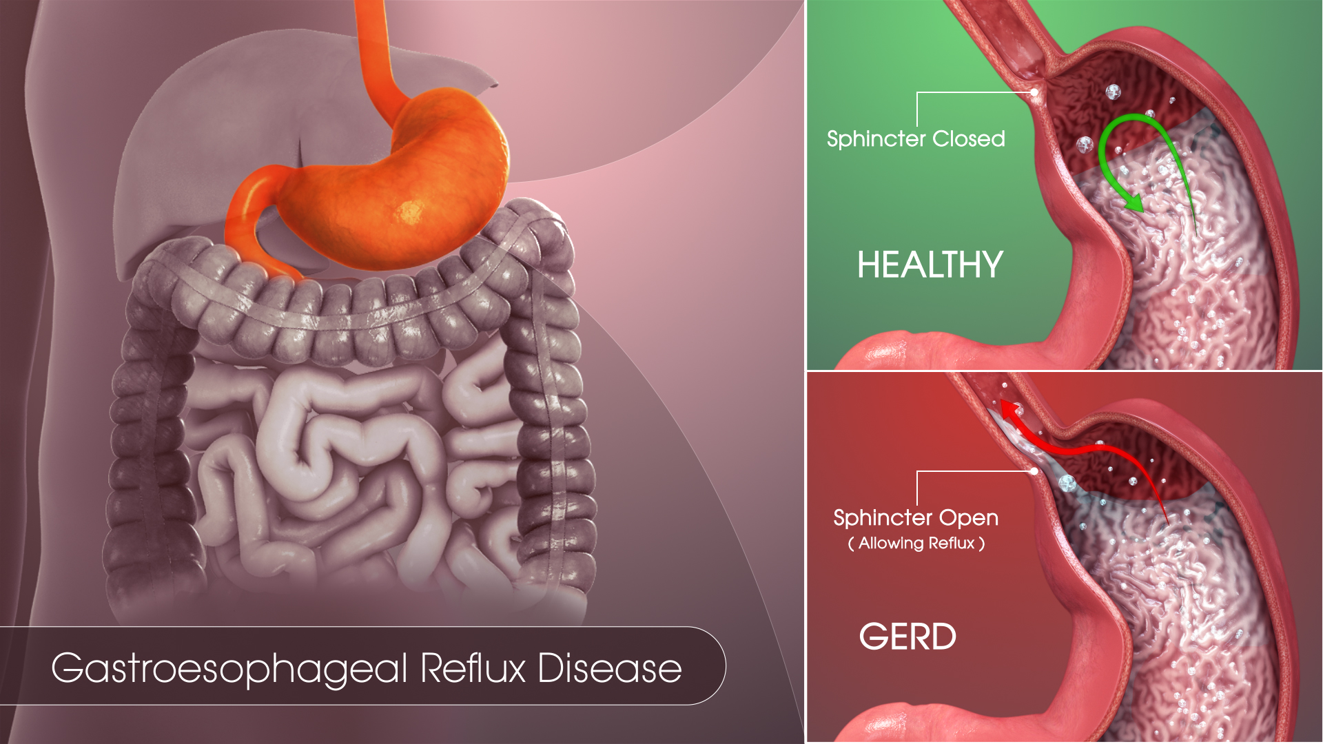 Gastroesophageal Reflux Disease GERD Symptoms Causes Risks Treatment