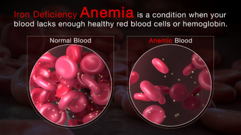 Iron Deficiency Anemia - Scientific Animations