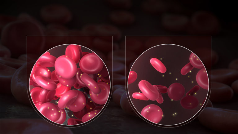 Iron Deficiency Anemia FI - Scientific Animations