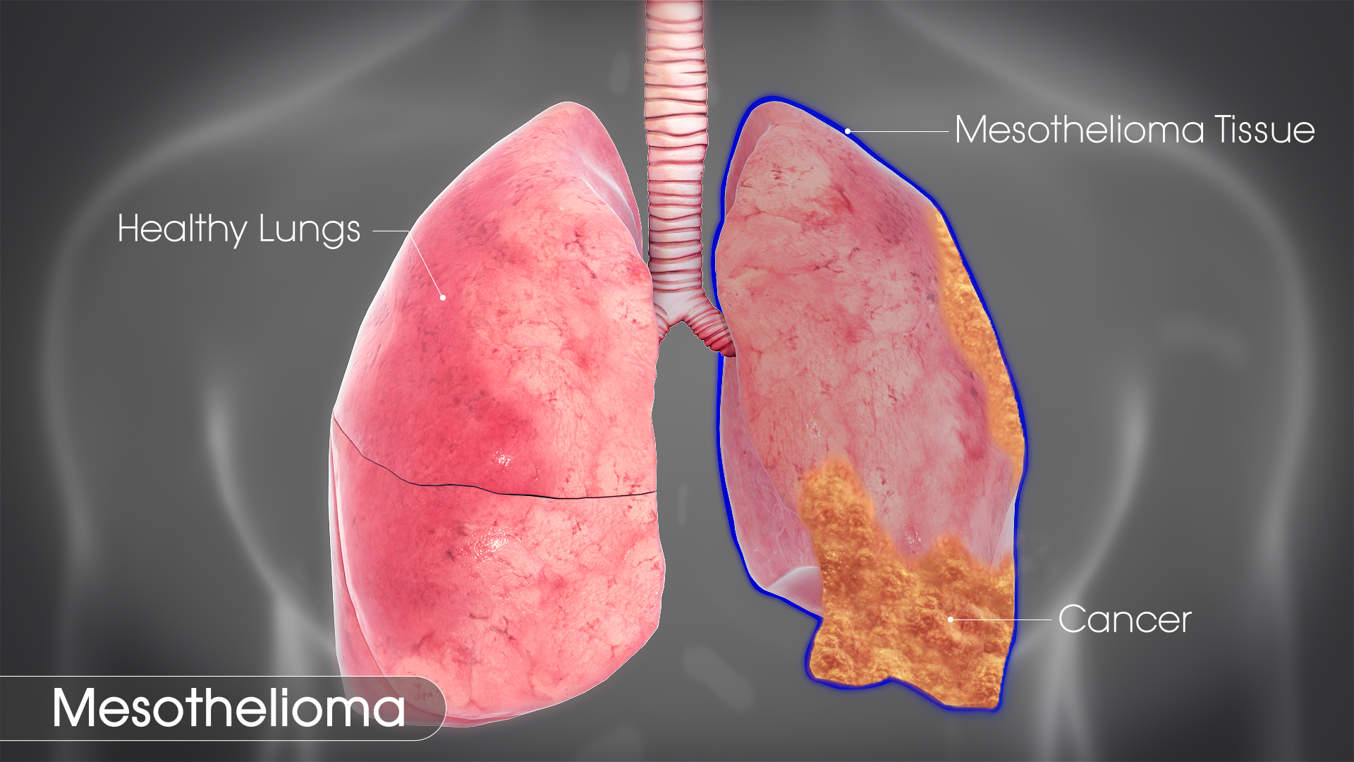 Mesothelioma Symptoms Causes And Treatment Scientific Animations
