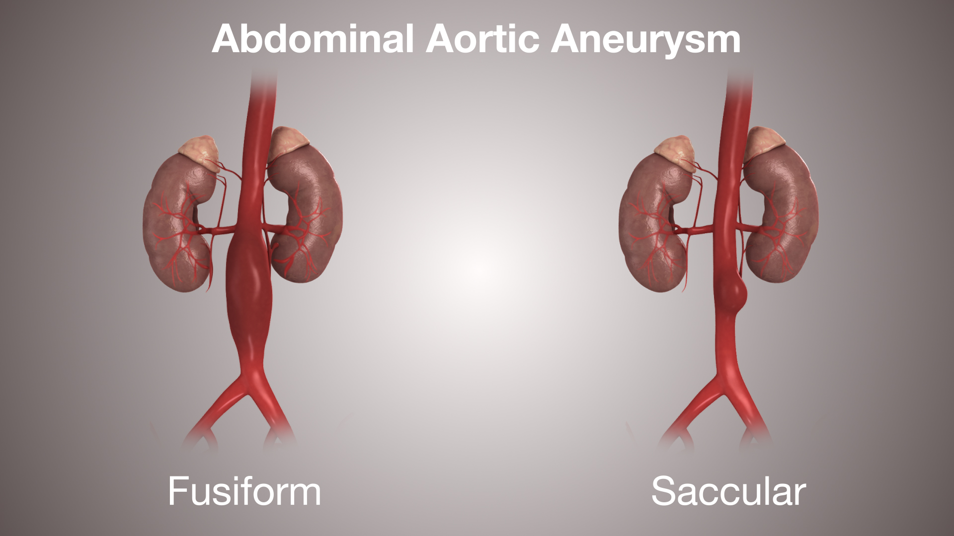 Abdominal Aortic Aneurysm Symptoms Causes And Treatment Scientific