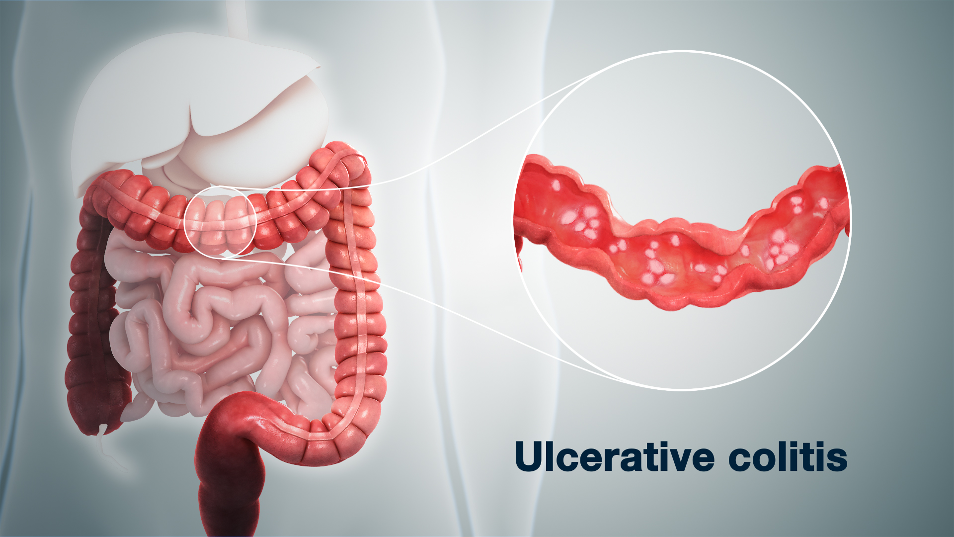 https://www.scientificanimations.com/wp-content/uploads/2020/01/3D-medical-animation-of-Ulcerative-Colitis.jpg