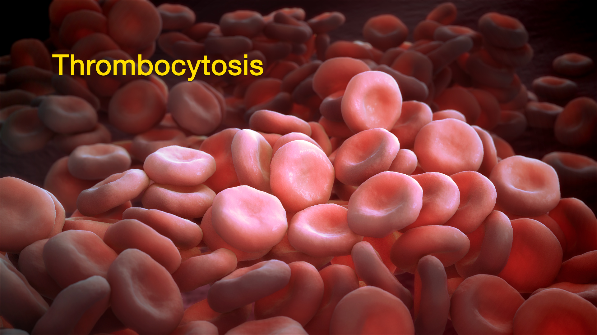 Thrombocytosis As Visualised By A 3D Medical Illustration