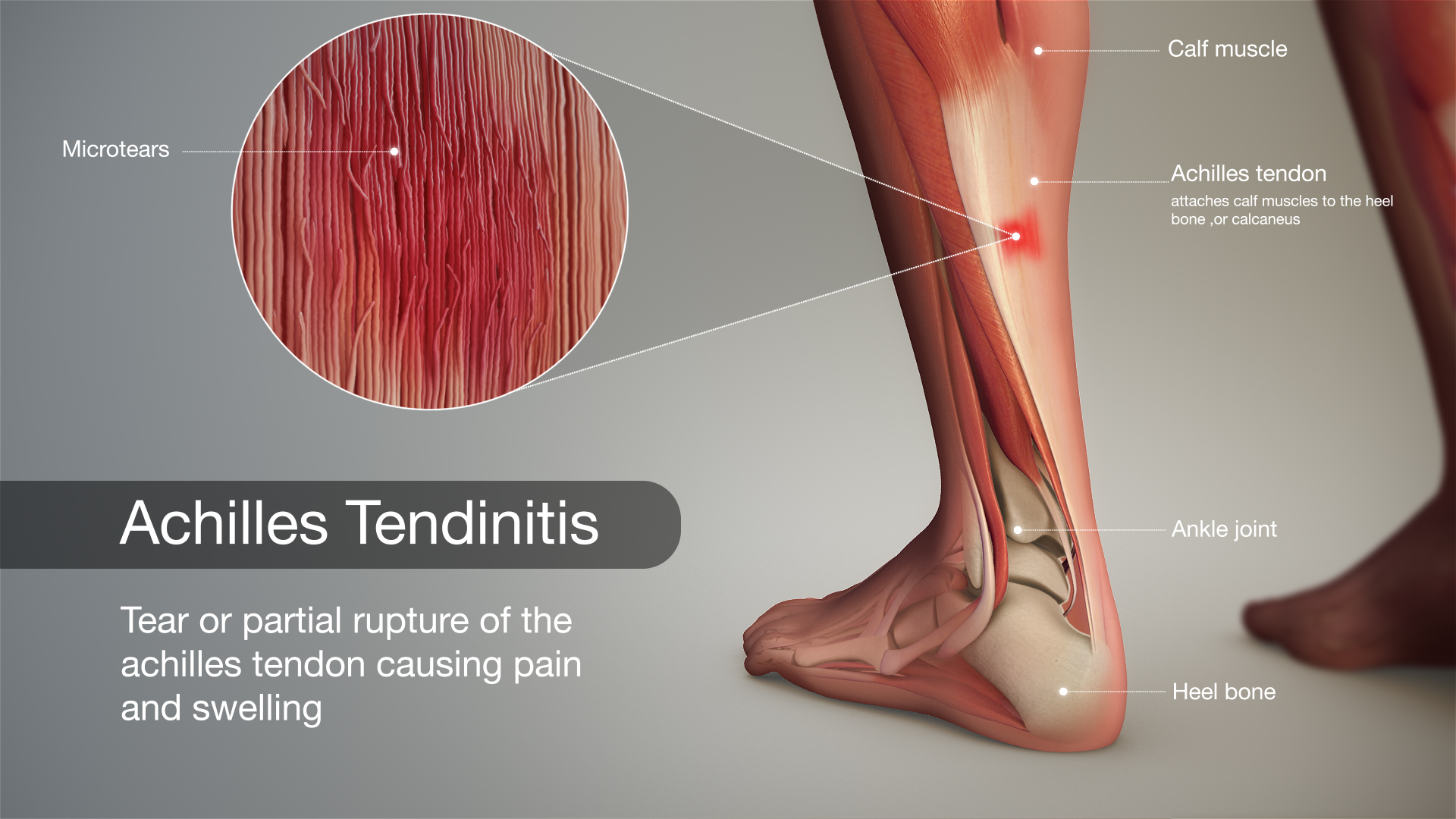 Achilles Tendon Tear Symptoms, Causes & Treatment