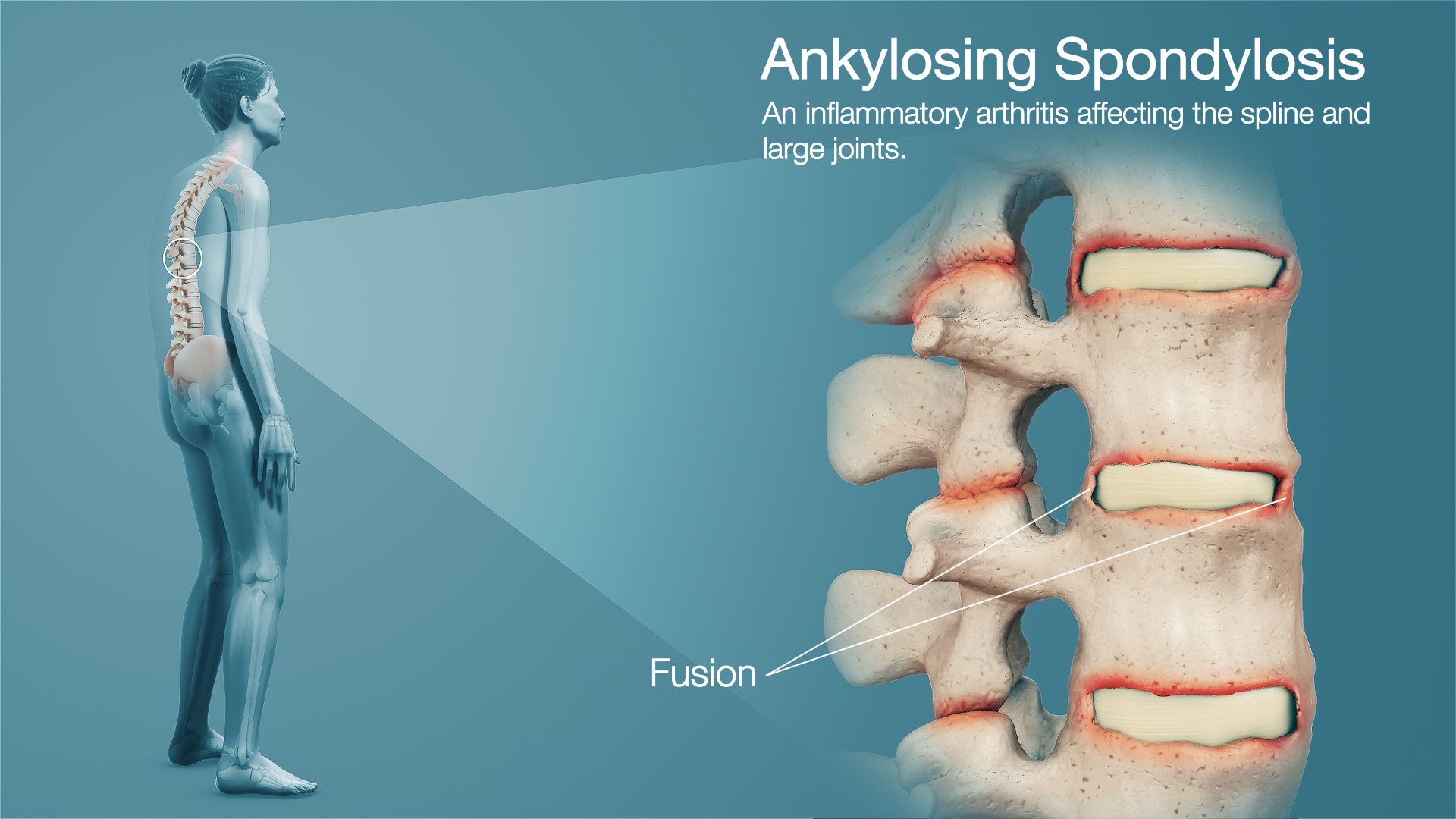 Ankylosing Spondylitis Depicted By 3d Medical Animation And Explained