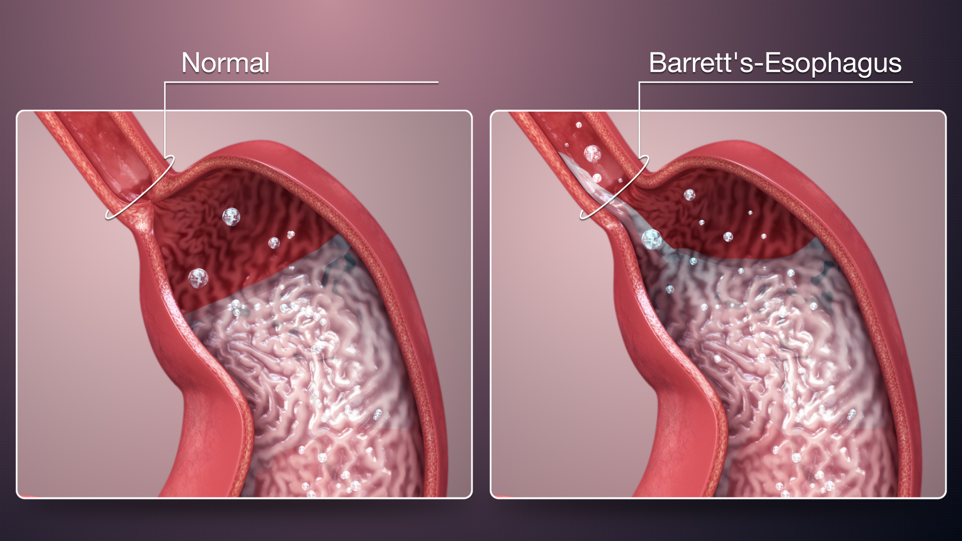 Barrett's Esophagus explained & shown using medical animation still shot