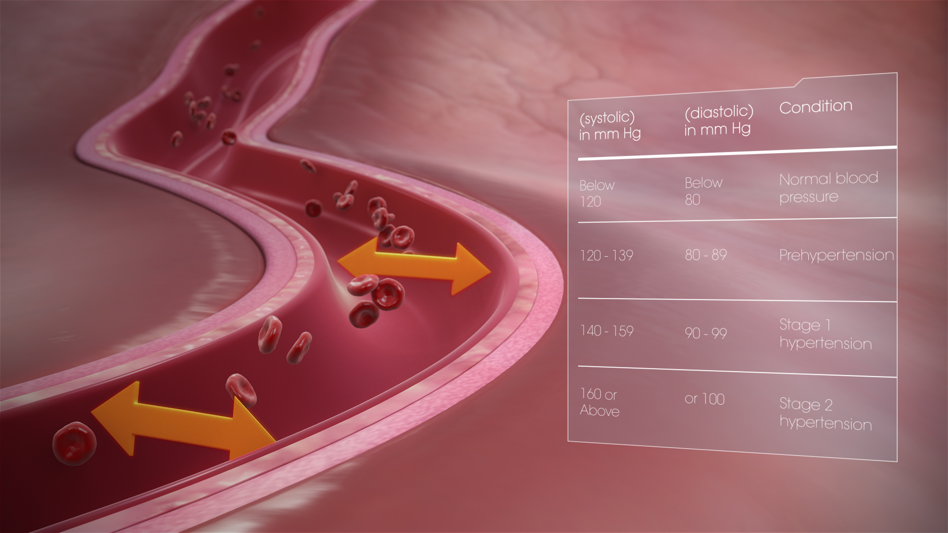 Medical Animation Still Shot Showing Different Conditions of Hypertension