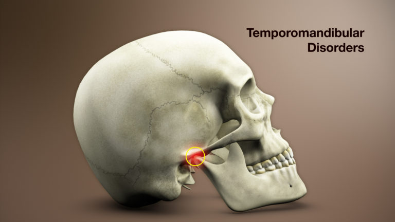 Temporomandibular Joint Disorder – Symptoms, Causes, & Treatment