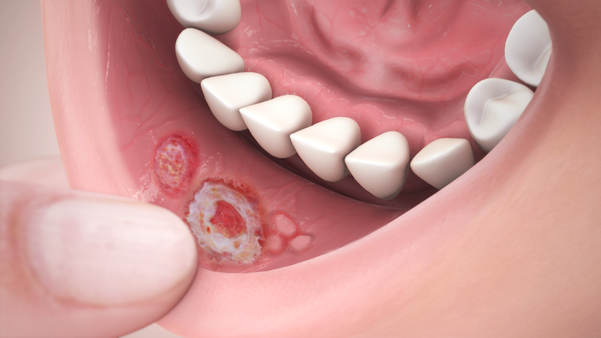 Aphthous Ulcers Shown And Explained Using Medical Animation Still Shot