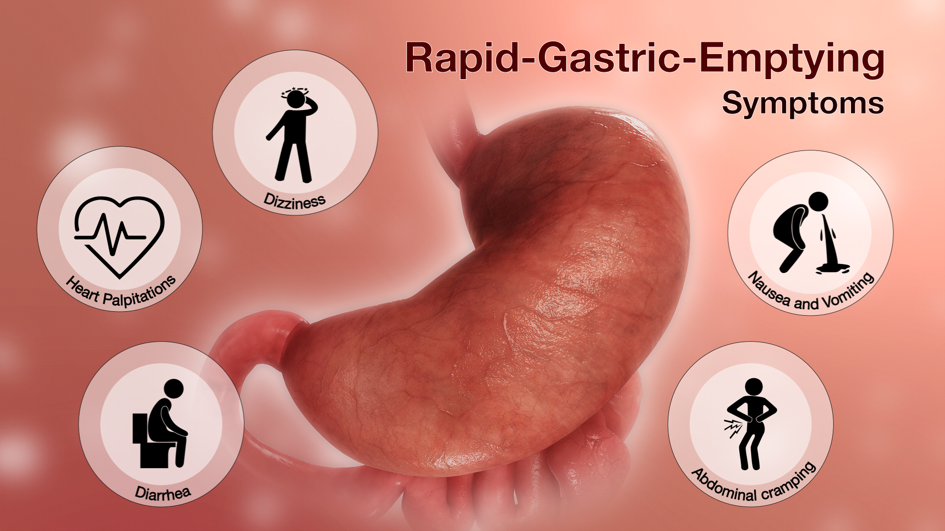 Rapid Gastric Emptying Symptoms Shown Using Medical Animation