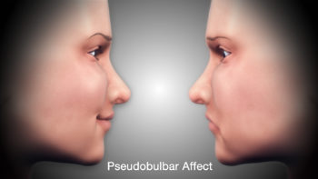 Pseudobulbar Affect – Symptoms, Causes, & Treatment