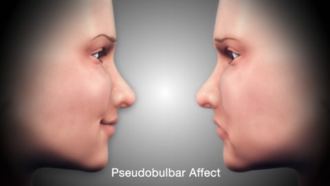 Pseudobulbar Affect – Symptoms, Causes, & Treatment