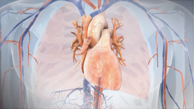 T7- Mitral Valve Replacement System - Scientific Animations